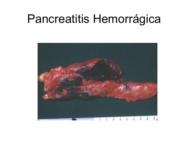 pancreatitis hemorragica